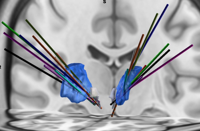 Deep Brain Stimulation